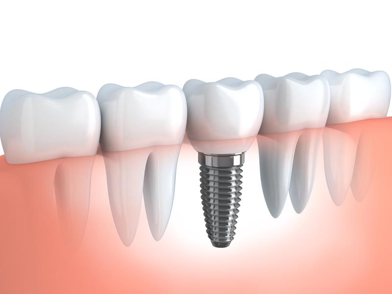 Dental Implants  Lake Worth, FL 